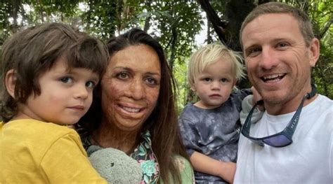 Turia Pitt S Story Her Recovery From Burns Thenetline