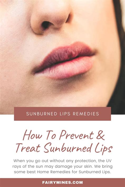 Best Home Remedies For Sunburned Lips How To Prevent And Treat