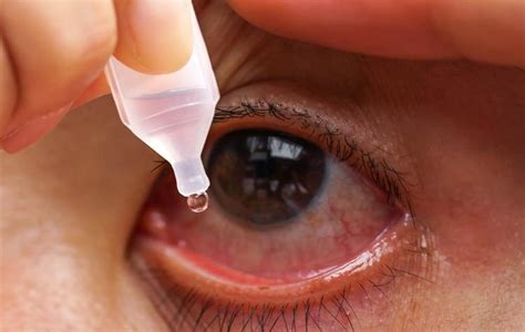 Obat Mata Merah Dengan Atau Tanpa Resep Dokter Good Doctor Tips