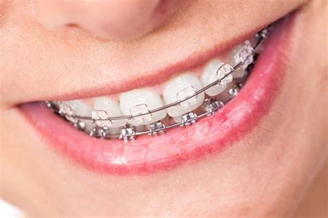 Benefits Of Clear Braces Frankford Dental Care Philadelphia Pennsylvania