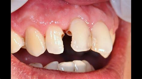 ฟันผุทะลุโพรงประสาทจะถอนฟันหรือรักษารากฟันดี ฟันกรามแตกแนวดิ่ง Stc Edu