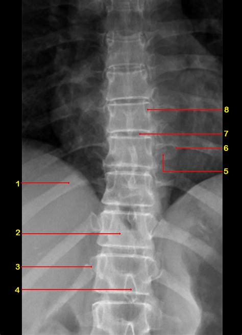 Thoracic Spine X Ray Labeled Cloudshareinfo