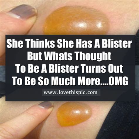 She Thinks She Has A Blister But It Turns Out To Be So Much Moreomg