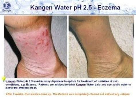 Eczema Before And After Water Board Pinterest