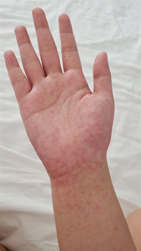 Help Woke Up With Small Red Itchy Bumps On Both Of My Hands Even In