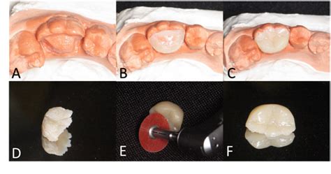 Indirect Restoration In Composite Resin A Clinical Report Of Self