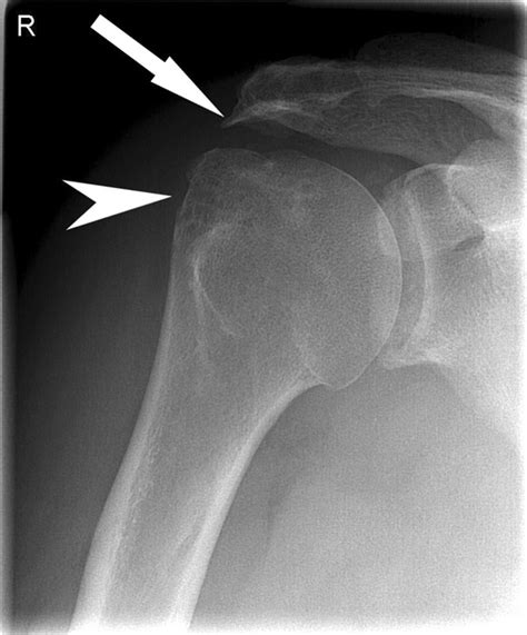 Anteroposterior Ap Conventional Radiographs Of The Shoulder