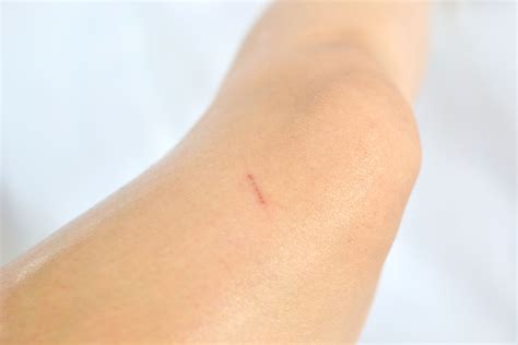 How to Use Olive Oil to Remove Scars: 3 Steps (with Pictures)