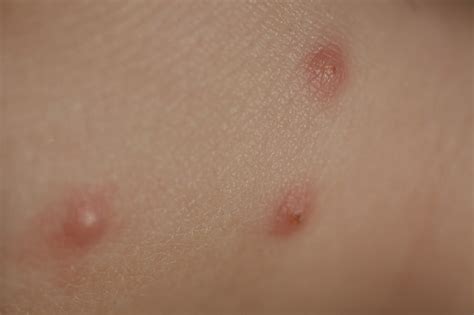 Insect Bites On Skin Child Stock Photo Download Image Now Istock