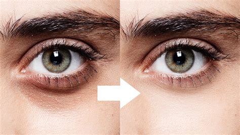 Dark Circles Under Eyes Causes Home Remedies And Medical Treatment