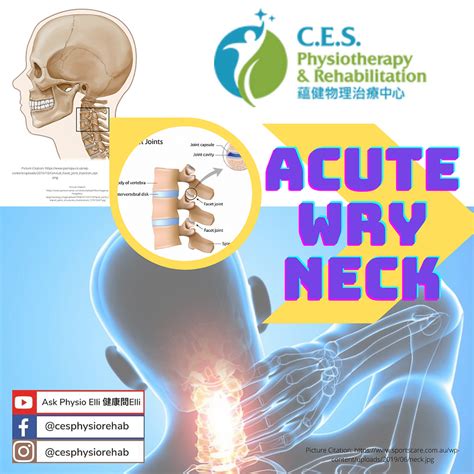 Acute Wry Neck