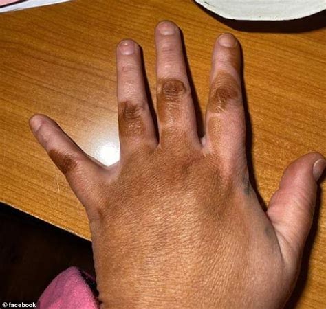 Wife Wakes To A Disastrous Fake Tan Fail Before A Romantic Weekend With