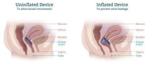 Eclipse™ For Treatment Of Fecal Incontinence Laborie
