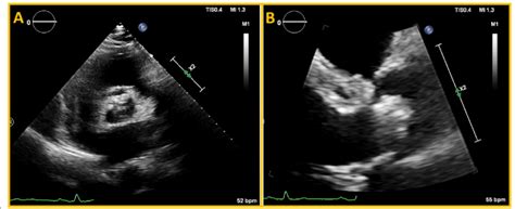 Aortic Valve Calcification In Parasternal Short Axis A And Long Axis