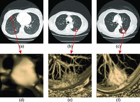 three types of lung nodules a isolated nodule b 3d image of download scientific diagram