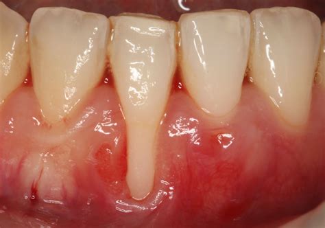 Recesión Gingival ¿qué Es Y Cómo Tratarla Clínica Dental Ortoperio