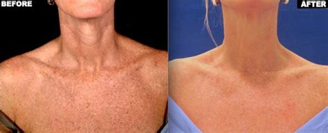 Sun Spots Unionderm The Art Science Of Skin