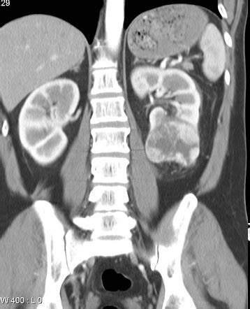 Renal Cell Carcinoma TNM Staging Radiology Reference Article