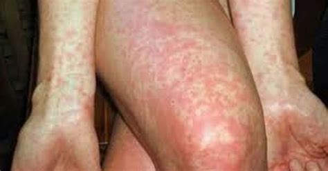 Scarlet Fever Outbreak In Hull Sees Highest Number Of Cases In Five