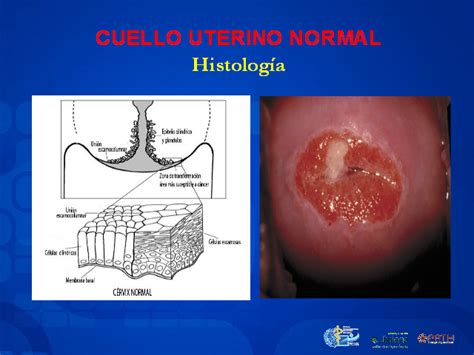 Dolor de espalda, dolor en los huesos o fracturas, fuga de orina o heces por la vagina, dolor pélvico, dolor en las piernas, fatiga, pérdida de peso, falta de apetito y piernas hinchadas. Prevención secundaria para cáncer de cuello uterino. IVAA ...