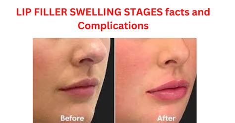 Lip Filler Swelling Stages Facts And Complications