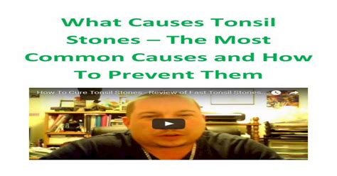 What Causes Tonsil Stones The Most Common Causes And How To Prevent