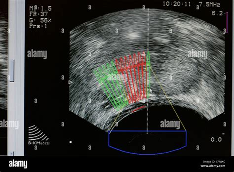 Cancer Of Prostate Ultrasound Stock Photo Alamy