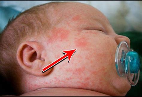 Symptoms Of Rice Allergy In Infants