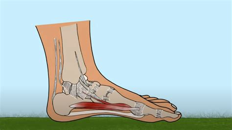 How To Fix Flat Feet Fallen Arches In 4 Steps By Barefoot Strength Barefoot Orthotics
