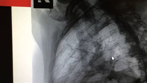 Displaced Rib Fractures Identification On X Ray And Treatment Youtube