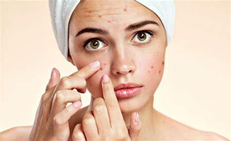 Acne How To Get Rid Of Acne
