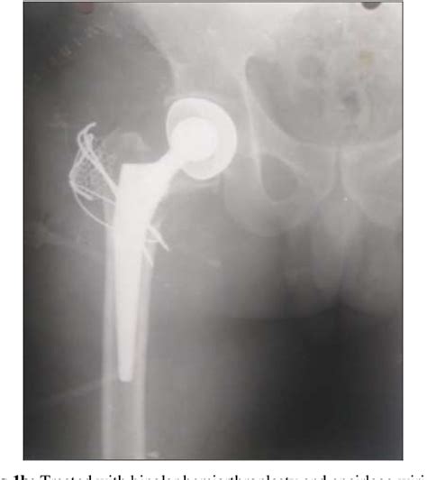 Figure 1 From Role Of Hemiarthroplasty In Comminuted Intertrochanteric