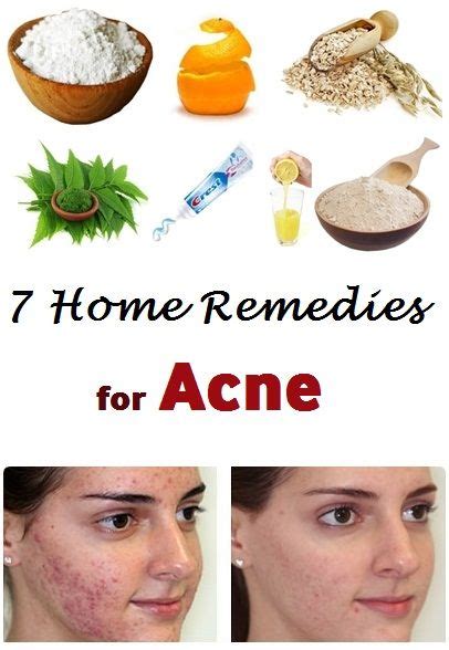 7 Home Remedies For Acne Beauty Steps Org Home Remedies For Acne