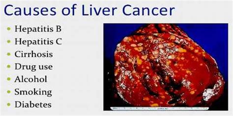 Cirrhosis of the liver is a type of liver damage where healthy cells are replaced by scar tissue. About Liver Cancer - Assignment Point