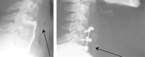 Radiographies Du Rachis Cervical De Profil De Deux Patients Mettant En