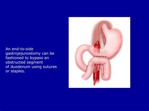ppt superior mesenteric artery sma syndrome powerpoint presentation id 1571556