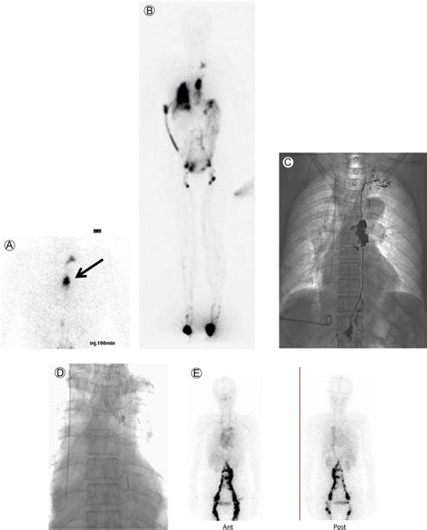 Lymphoscintigraphy For Imaging Of The Lymphatic Flow Disorders