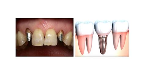 Tout Savoir Sur L Implant Dentaire Allodocteurs