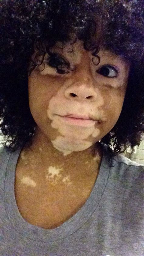 Am I Cute Or Naw What Is Vitiligo Vitiligo Vitiligo Treatment