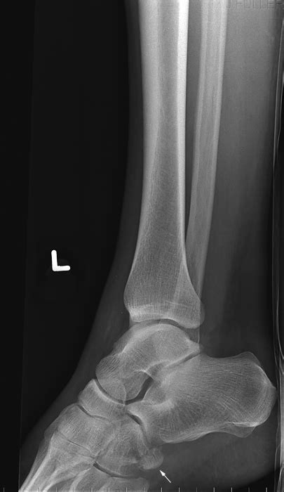 Nutcracker Fracture Of The Cuboid Wikiradiography