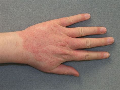 Allergic Contact Dermatitis Types Causes And Treatments Allergic