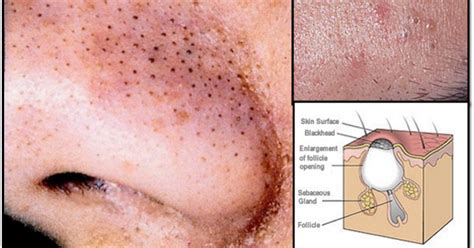 Acne Causes Pictures Symptoms And Treatment
