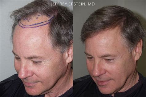 Hair Transplants For Men Photos Miami Fl Patient