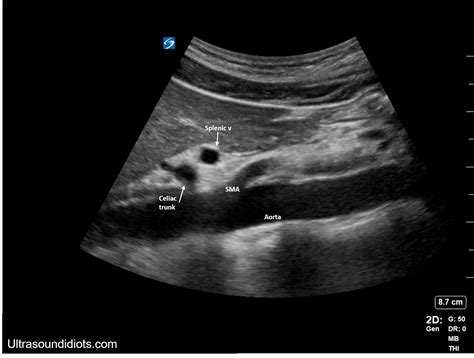 Aorta Anatomy Ultrasound