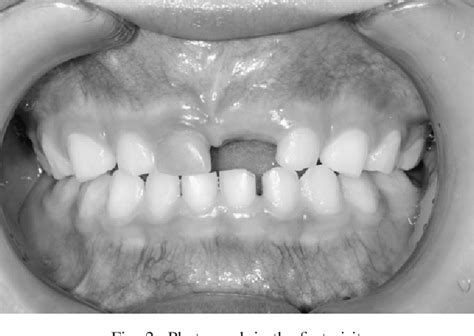 Figure 2 From Management Of The Malposition Tooth That Was Caused By