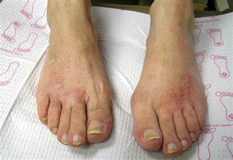 Athletes Foot Causes And Symptoms