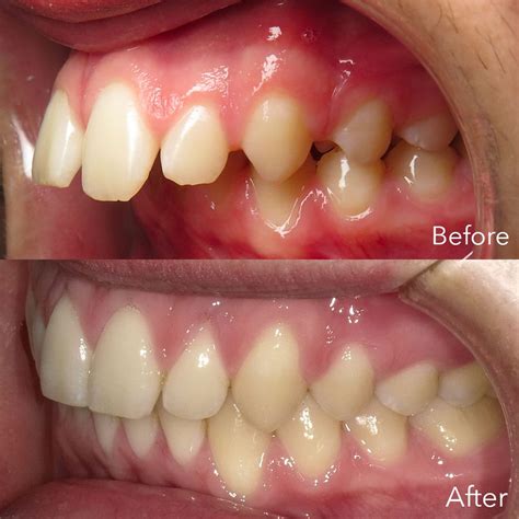 Find an invisalign trained orthodontist near you today! How To Fix an Overbite Using a Carriere Distalizer and ...