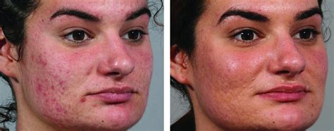 Intensif Microneedling For Acne Scars By Endymed