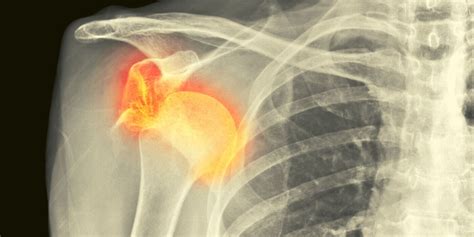 Shoulder Dislocation Causes Recovery Physiotherapy