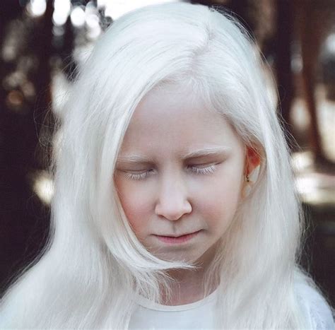 A Photographer Captures People With Albinism To Show Their Stunning And